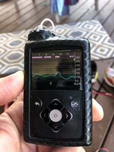 Medtronic 670G Insulin Pump with CGMS