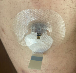 CGMS Inserted sensor with 1st tape