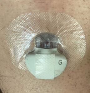 CGMS Inserted sensor with transmitter